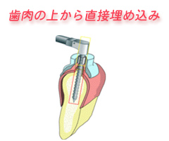 歯肉の上から直接埋め込み
