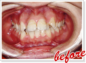 上顎前突 before