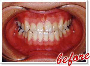 反対咬合 before